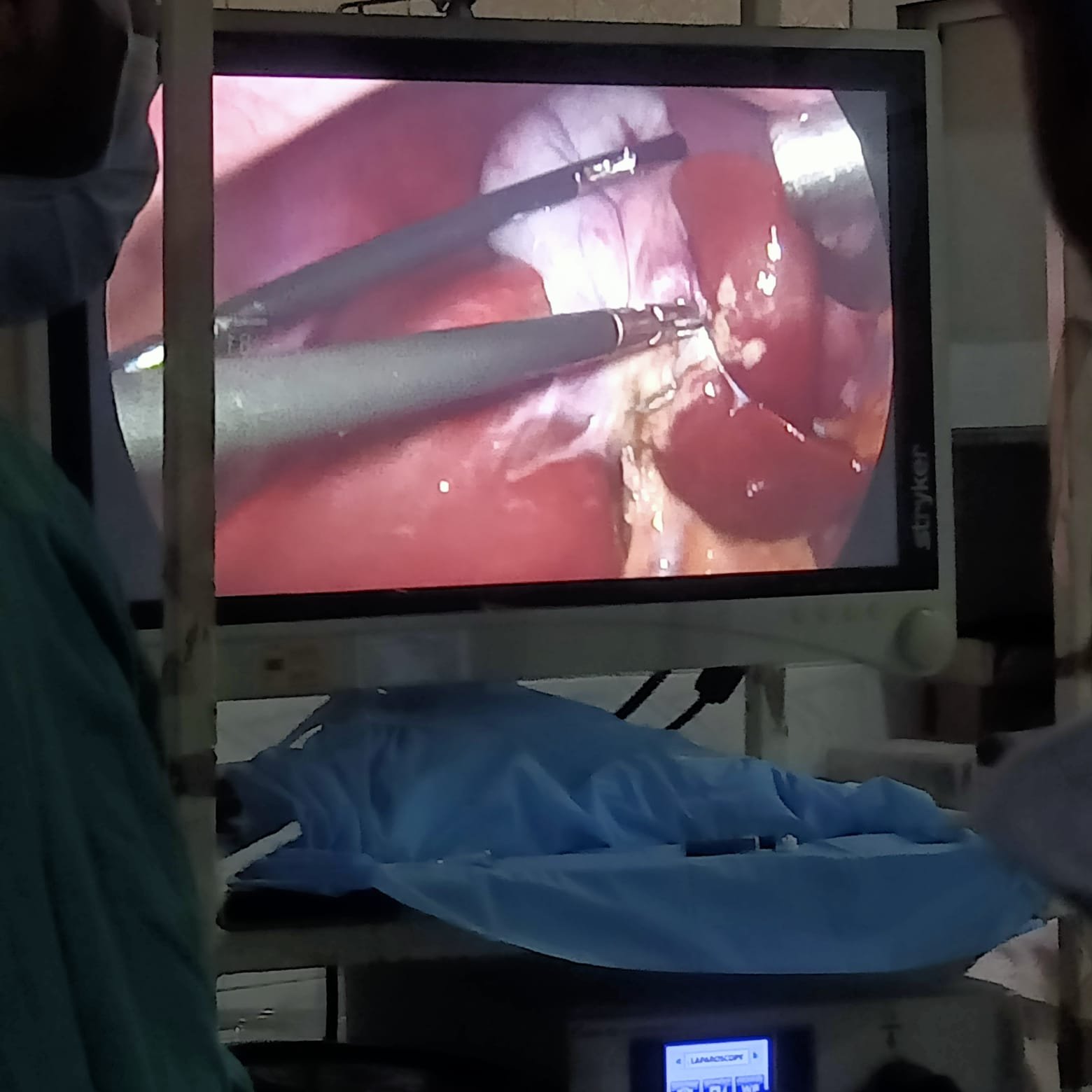 Laparoscopic Surgery